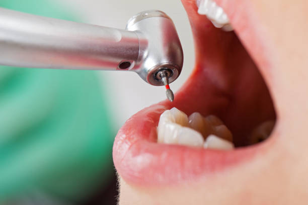 Best Knocked-Out Tooth (Avulsed Tooth) Treatment in Sheridan, CO